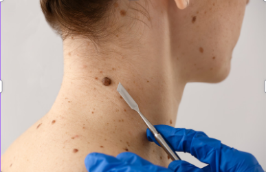 Lesion removal at Southwest Skin Clinic, Strathroy